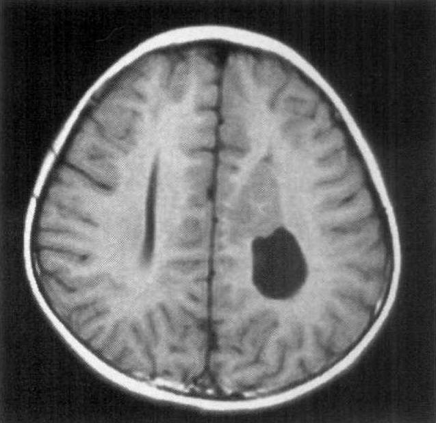 病例9 脑灰质异位伴胼胝体发育不良
